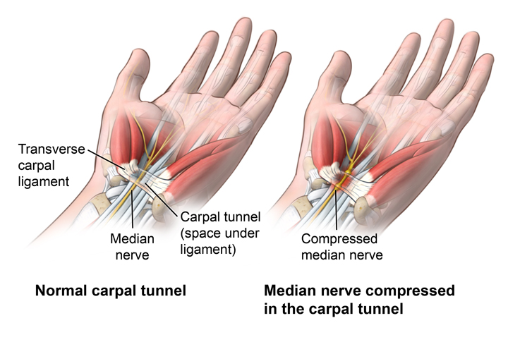 Treatment-Options-for-Carpal-Tunnel-Syndrome